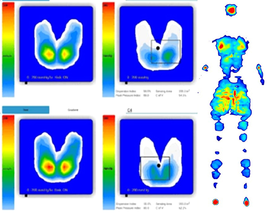 Pressure Mapping Display showing the colour guide of low to high risk pressure areas.